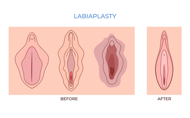 Labioplasti Ameliyatı Nasıl Yapılır